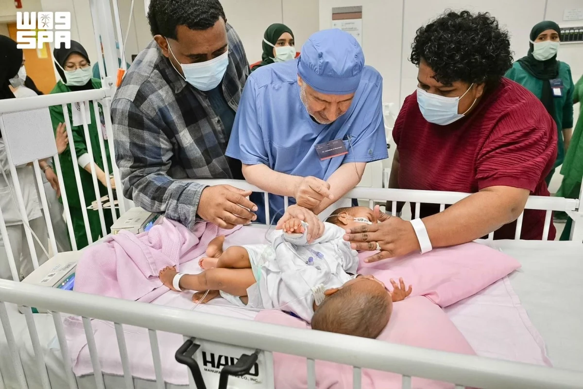 توأم فيجي تفصل بنجاح بعد 15 ساعة من الجراحة المعقدة في الرياض